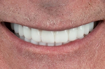 All on 6 implant tedavisi karşılaştırması sonrası görünüm
