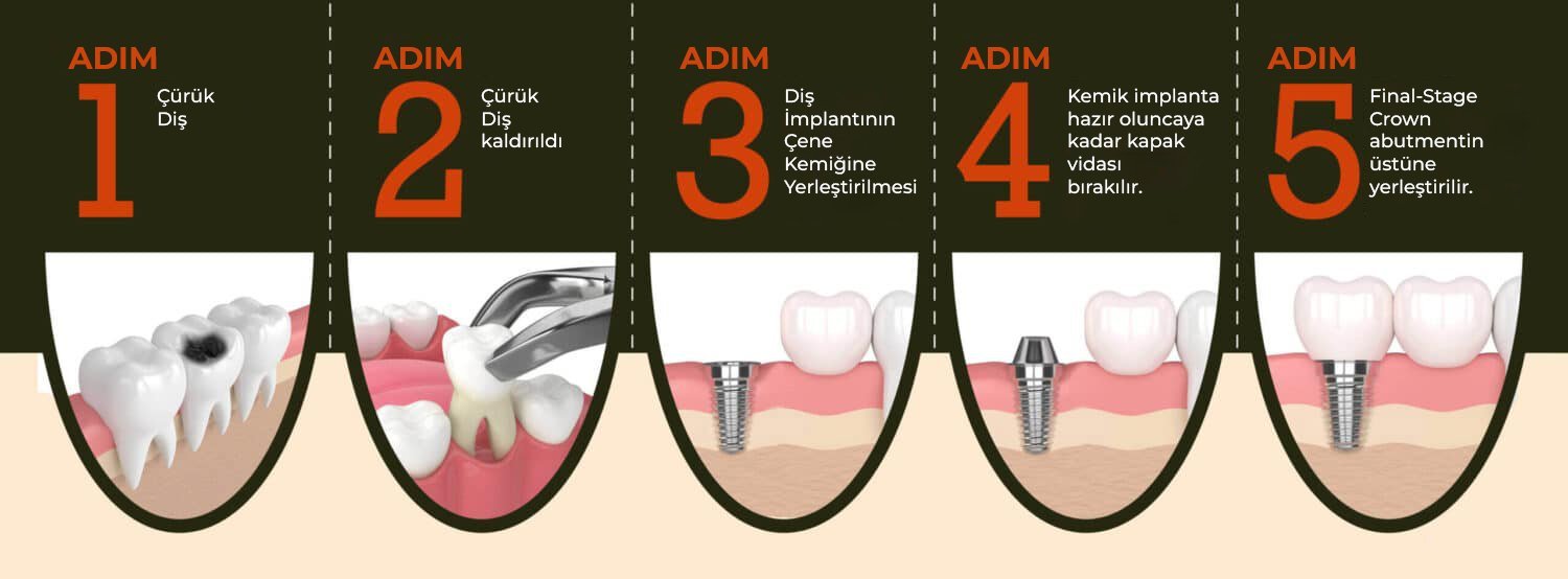 implant tedavisi